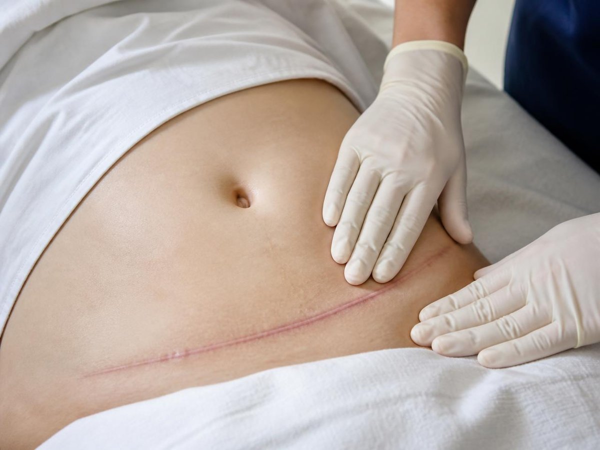 Fisioterapeuta a mobilizar cicatriz abdominal em sessão clínica
